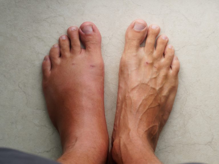 Swollen Leg After A Wasp Bite.