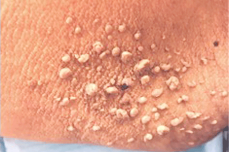 Skin Tag Sudden Development 1
