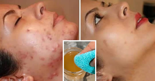 Aceto Di Mele Macchie Acne