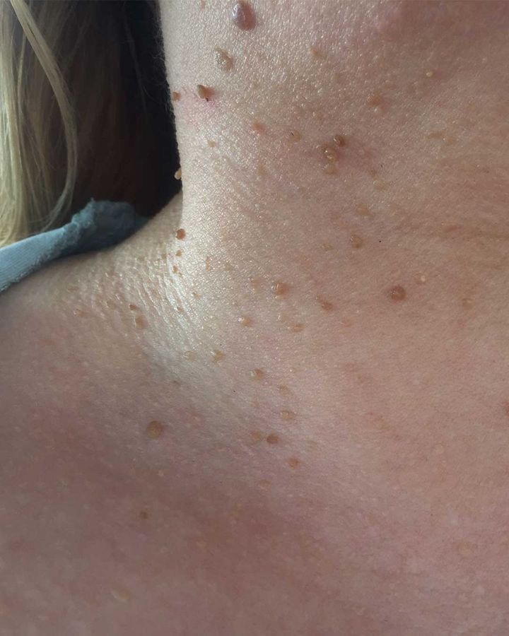 Effective Natural Methods For Mole Removal From Skin