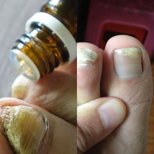 Uncover The Amazing Solution That Effectively Eliminates Toenail Fungus For Good